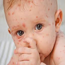 Chicken pox