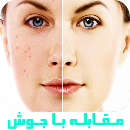 مقابله با جوش صورت