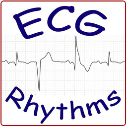 ECG Rhythm