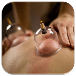 Cupping and medical healing