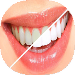 روش های سفیدی دندان