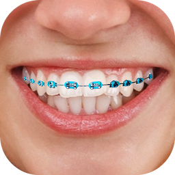 Braces : Add Braces On Photo