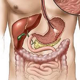 همه چیز درباره ی زخم معده