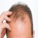 ریزش مو و درمان با طب سنتی