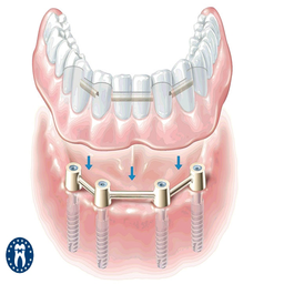 Home treatment for toothache