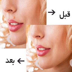 برداشتن خال گوشتی
