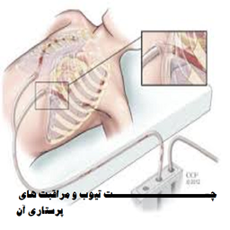 چست تیوب ومراقبت های آن