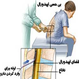 درمان عوارض بی حسی نخاعی