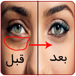 درمان کبودی زیر چشم تا عید