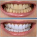 سفیدکردن دندان