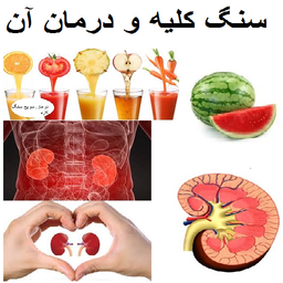 سنگ کلیه و درمان آن (گرافیکی)