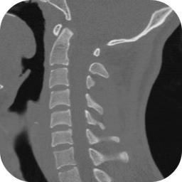 CT Cervical Spine