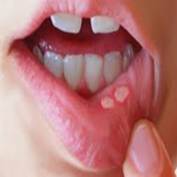 درمان گیاهی آفت دهان