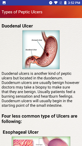 Peptic Ulcers Help & Diet Tips - Image screenshot of android app