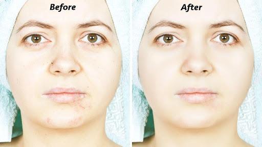 Pimple Eraser Photo Editor - Image screenshot of android app