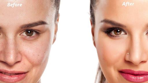 Pimple Eraser Photo Editor - Image screenshot of android app