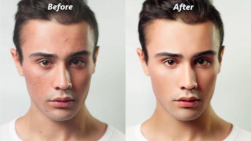 Pimple Eraser Photo Editor - Image screenshot of android app