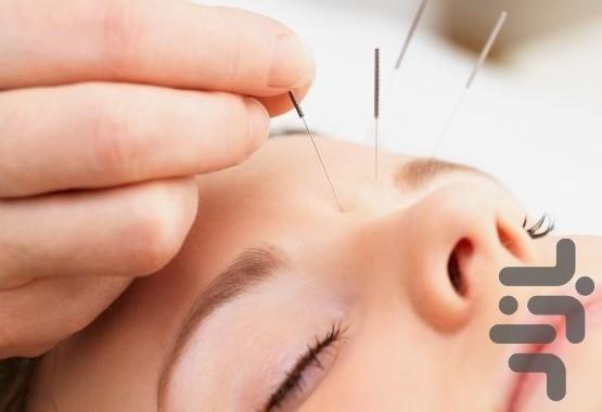 درمان با طب سوزنی - Image screenshot of android app