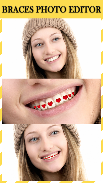 Braces : Add Braces On Photo - عکس برنامه موبایلی اندروید