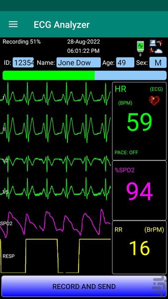 JamS3 ECG Analyser - Image screenshot of android app