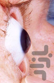 بیماری های چشم - عکس برنامه موبایلی اندروید