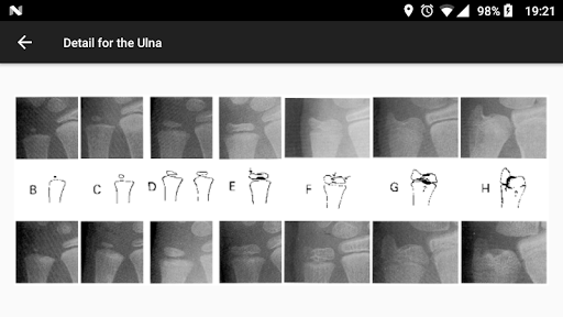Bone age - عکس برنامه موبایلی اندروید