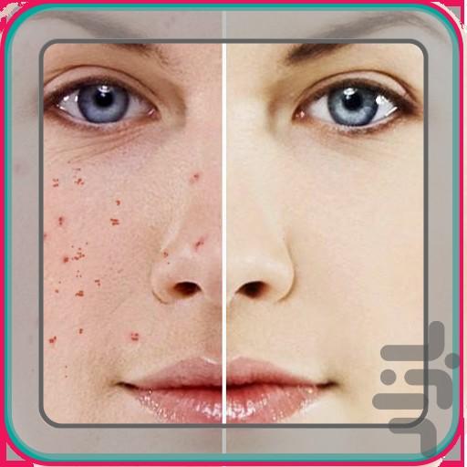 Acne treatment - عکس برنامه موبایلی اندروید