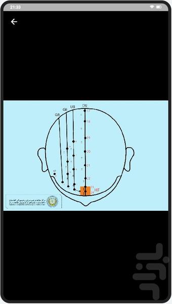 طب سوزنی پوست سر ژو - عکس برنامه موبایلی اندروید